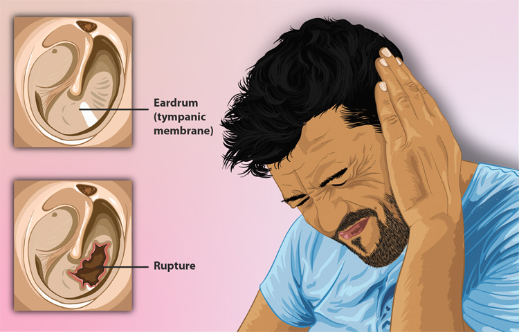 Tímpano perfurado: rasgo no tímpano causa muita dor |  Ilustração: Creative Commons