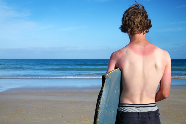 Protetor solar: proteja a pele do seu surfista aplicando protetor solar FPS 30 plus |  Foto: Shutterstock