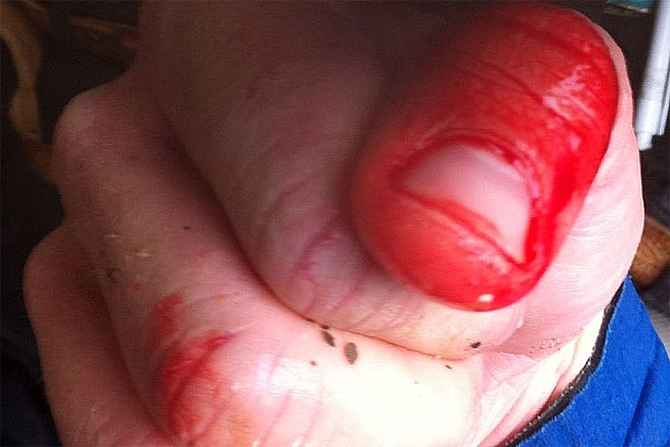 Ataque de tubarão: Rich Thomson foi agarrado pela perna e mordido por um tubarão liso de um metro