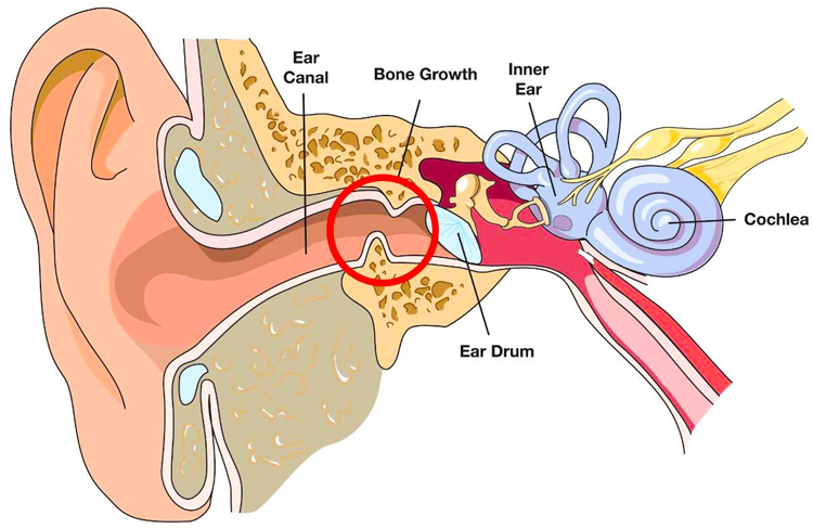 Orelha de surfista: um crescimento ósseo benigno sob a pele do conduto auditivo externo