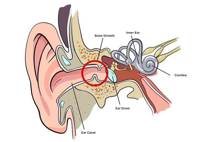Ouvido de surfista: crescimento ósseo anormal no canal auditivo só pode ser interrompido com protetores auriculares |  Ilustração: orelhas de surf